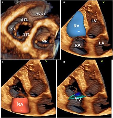 The atrial secondary tricuspid regurgitation is associated to more favorable outcome than the ventricular phenotype
